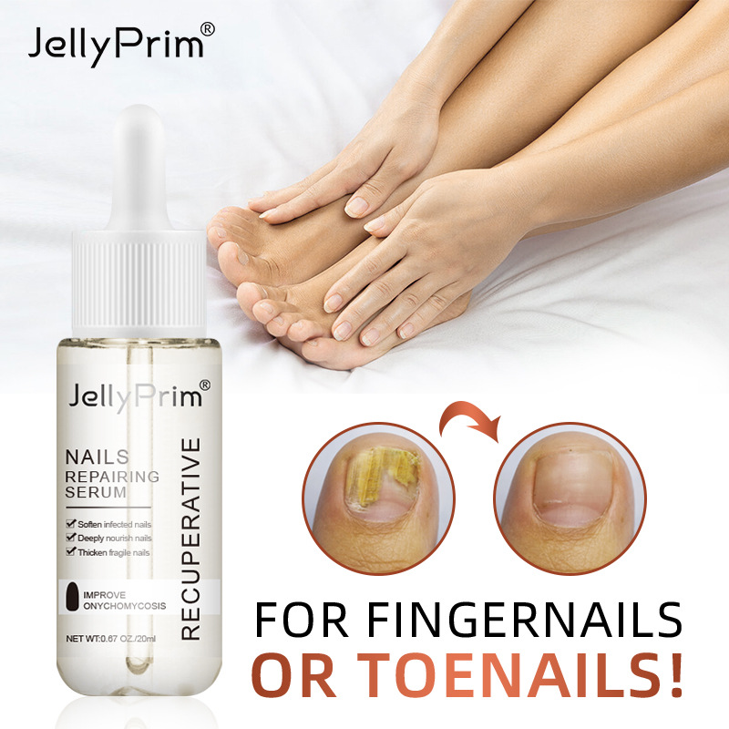 Onychomycosis lotion